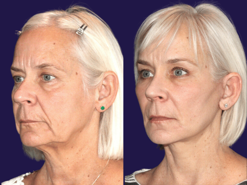 before and after face lift