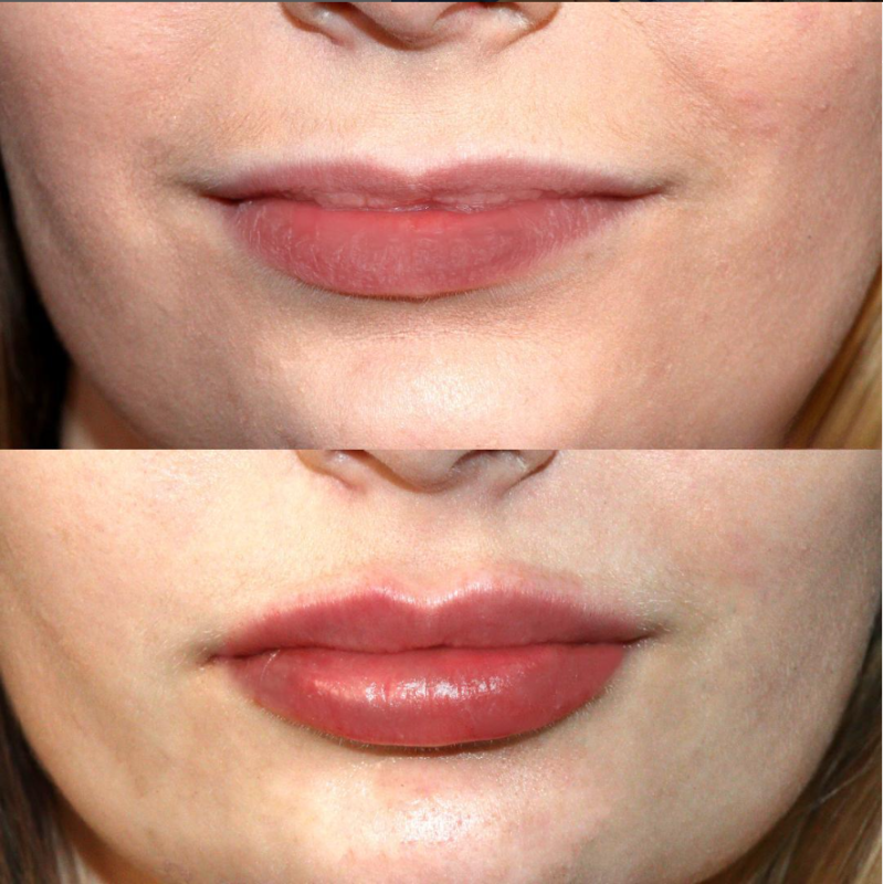 before and after lip filler